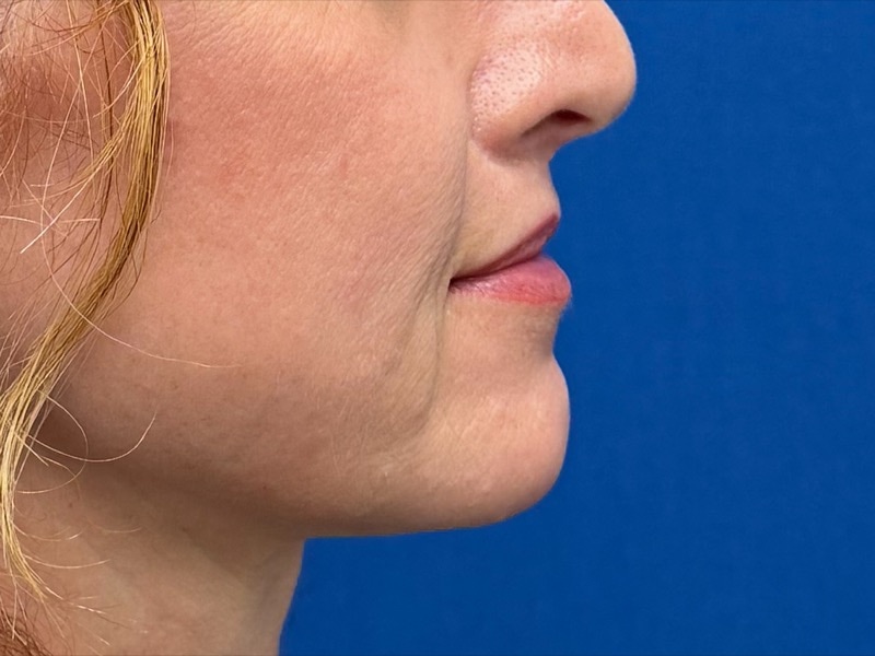 Lip Lift Before & After Image