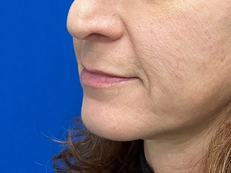 Lip Lift Before & After Image