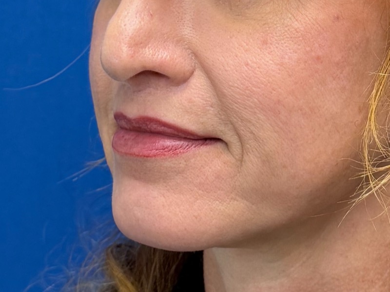 Lip Lift Before & After Image