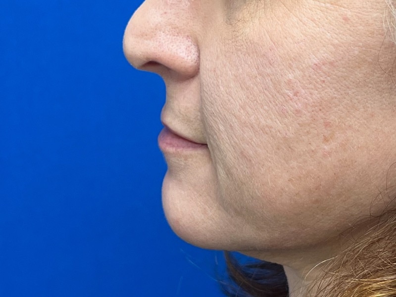 Lip Lift Before & After Image