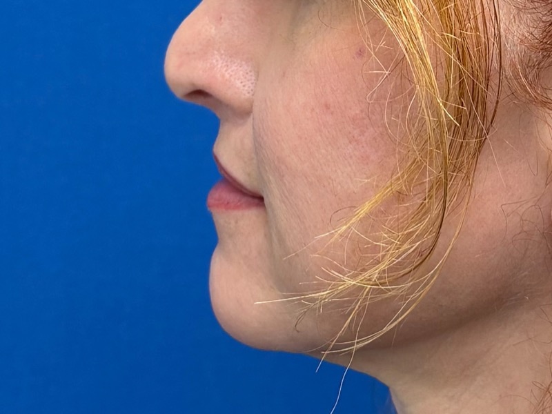 Lip Lift Before & After Image