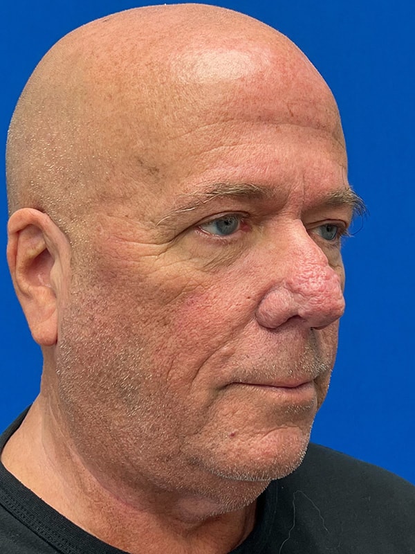 Rhinophyma Before & After Image