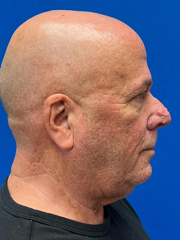 Rhinophyma Before & After Image