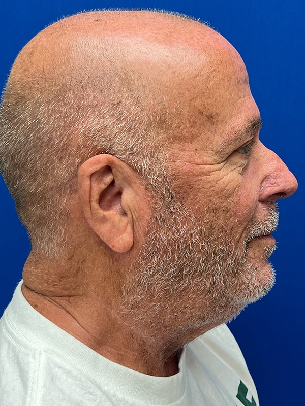 Rhinophyma Before & After Image
