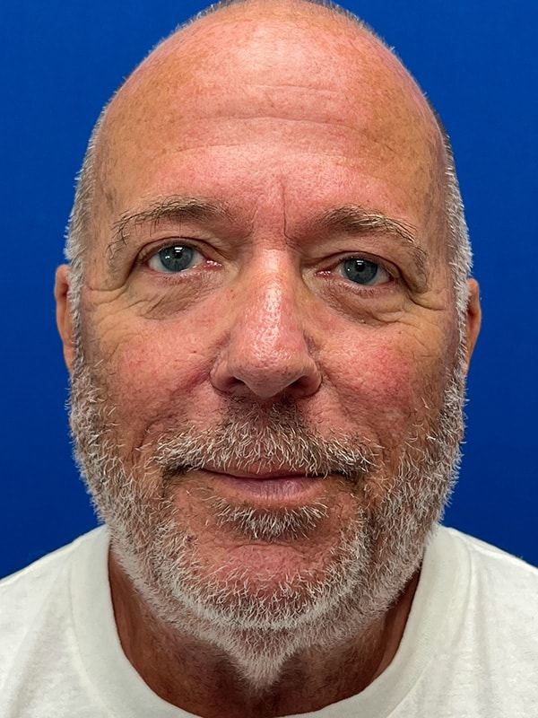 Rhinophyma Before & After Image