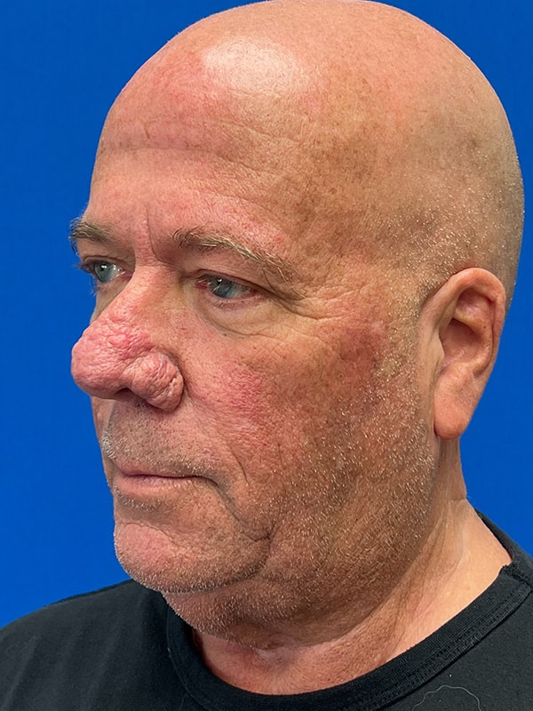 Rhinophyma Before & After Image