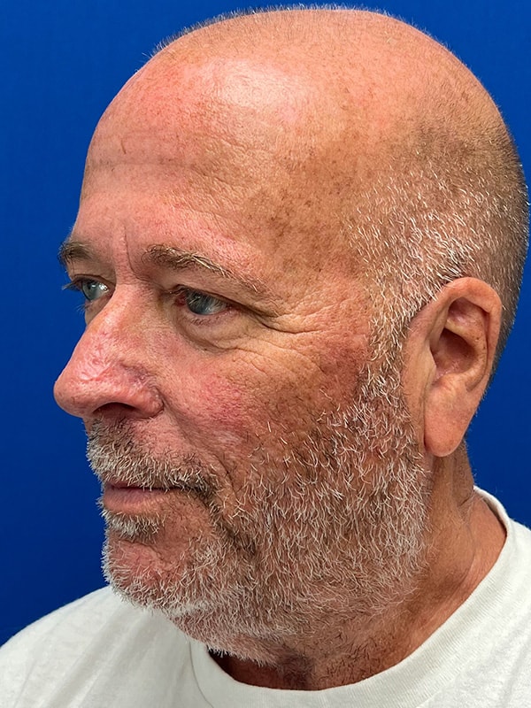Rhinophyma Before & After Image