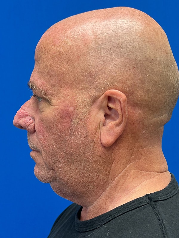 Rhinophyma Before & After Image
