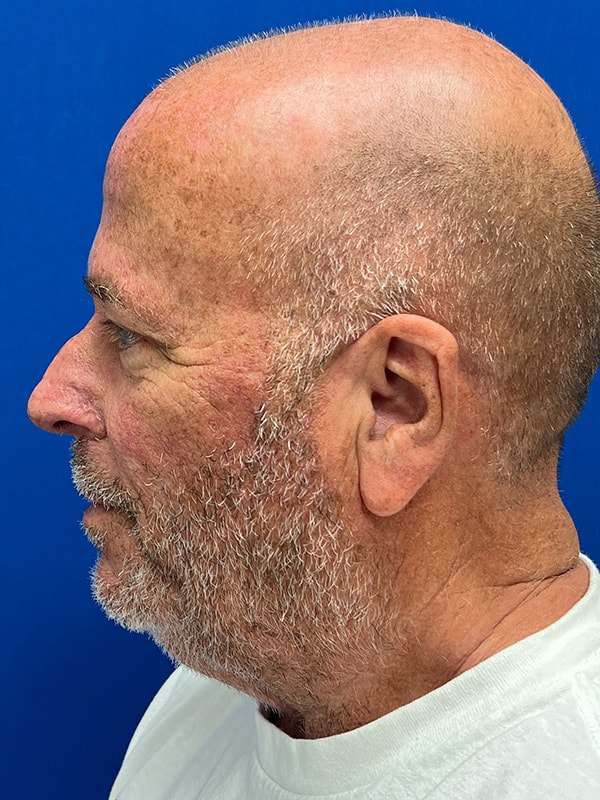 Rhinophyma Before & After Image