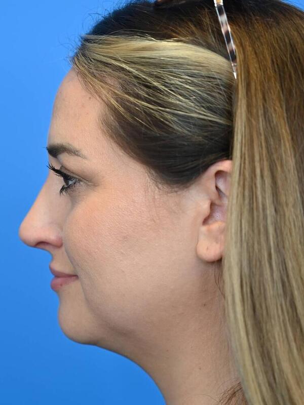 Rhinoplasty Before & After Image