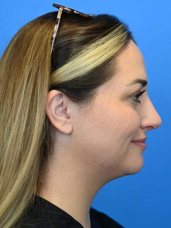 Rhinoplasty Before & After Image