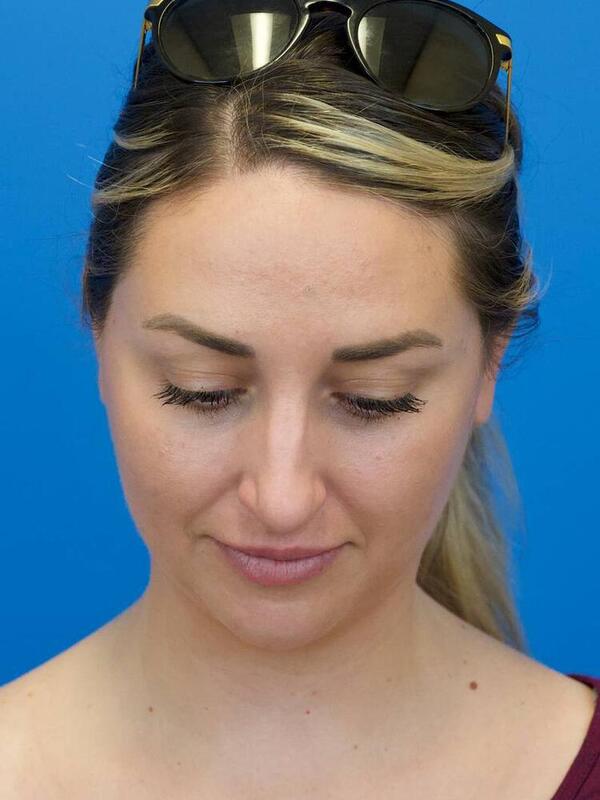 Rhinoplasty Before & After Image