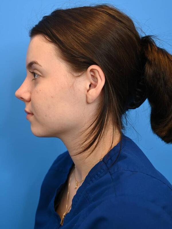 Rhinoplasty Before & After Image