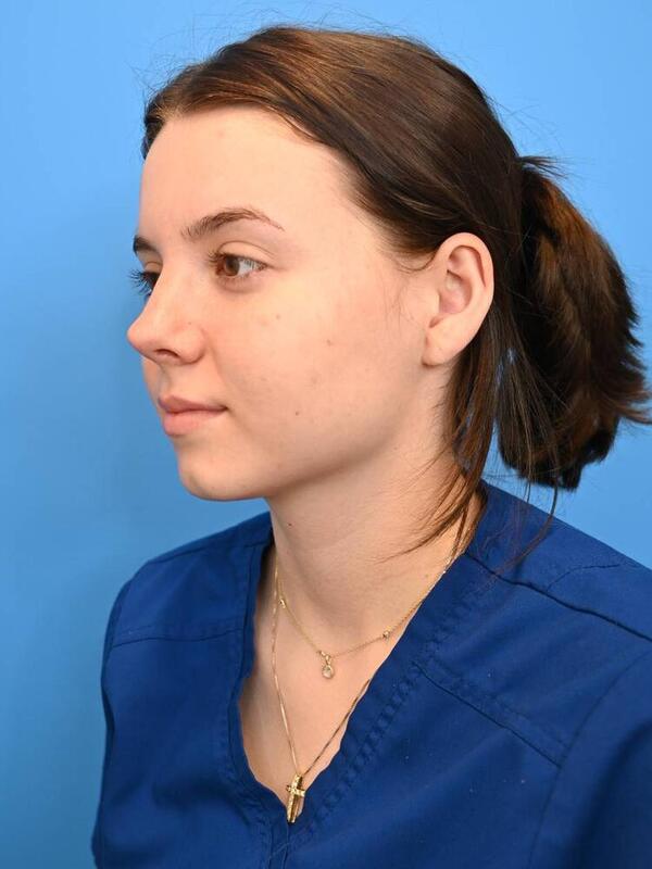 Rhinoplasty Before & After Image