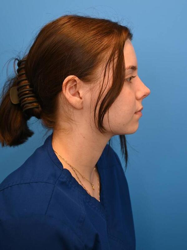 Rhinoplasty Before & After Image