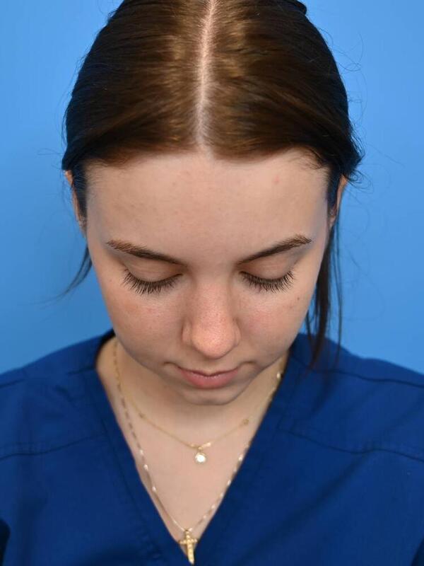 Rhinoplasty Before & After Image