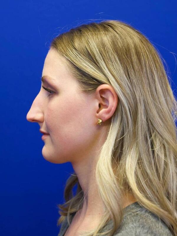 Rhinoplasty Before & After Image