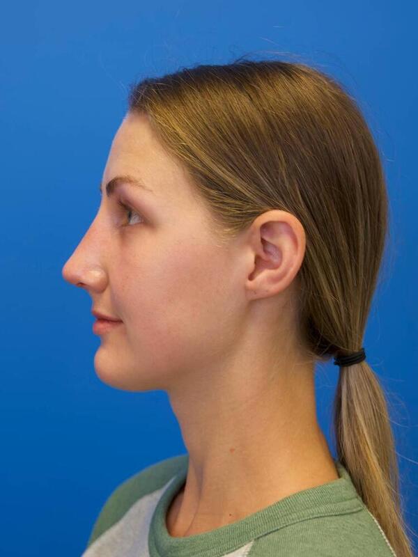 Rhinoplasty Before & After Image