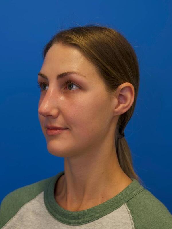 Rhinoplasty Before & After Image