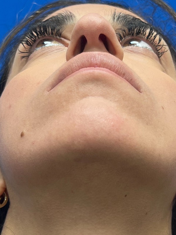 Rhinoplasty Before & After Image