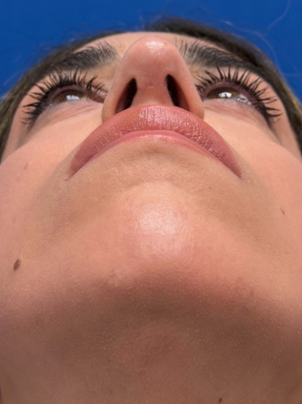 Rhinoplasty Before & After Image
