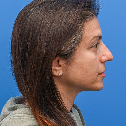 Rhinoplasty Before & After Image