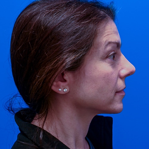 Rhinoplasty Before & After Image