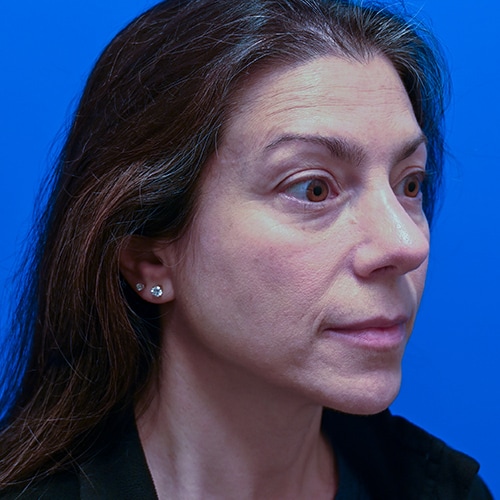 Rhinoplasty Before & After Image