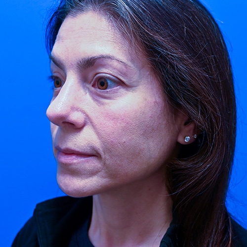 Rhinoplasty Before & After Image