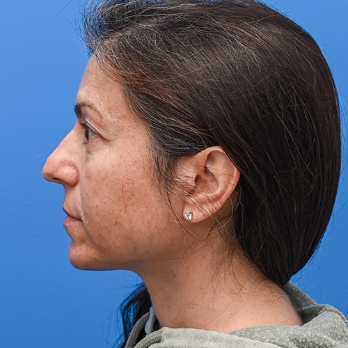 Rhinoplasty Before & After Image