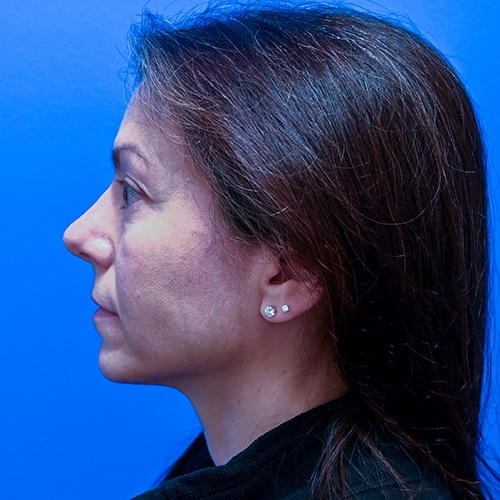 Rhinoplasty Before & After Image