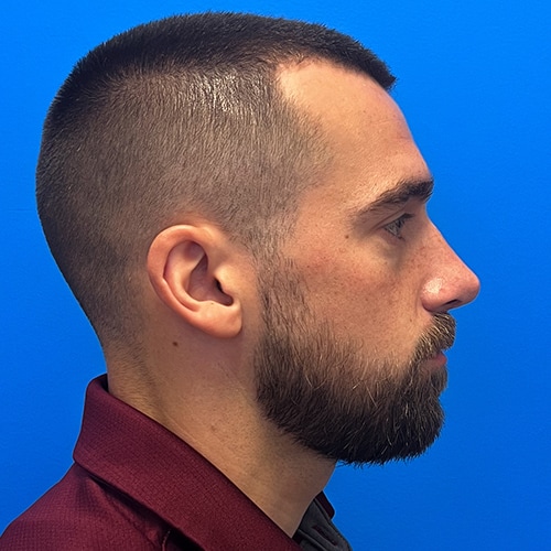 Rhinoplasty Before & After Image