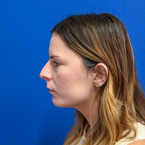 Rhinoplasty Before & After Image