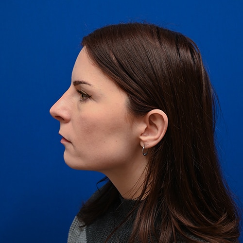 Rhinoplasty Before & After Image