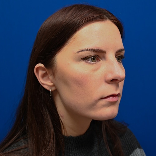 Rhinoplasty Before & After Image