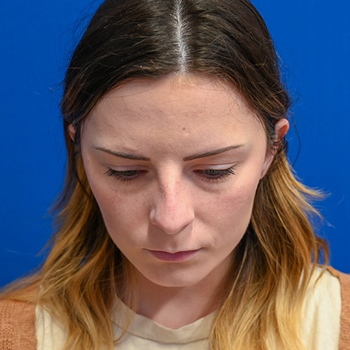 Rhinoplasty Before & After Image