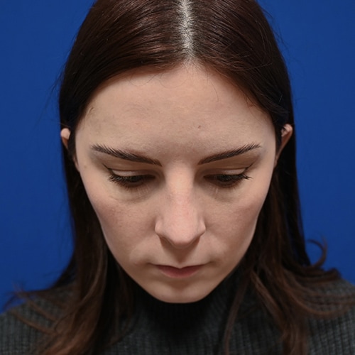 Rhinoplasty Before & After Image