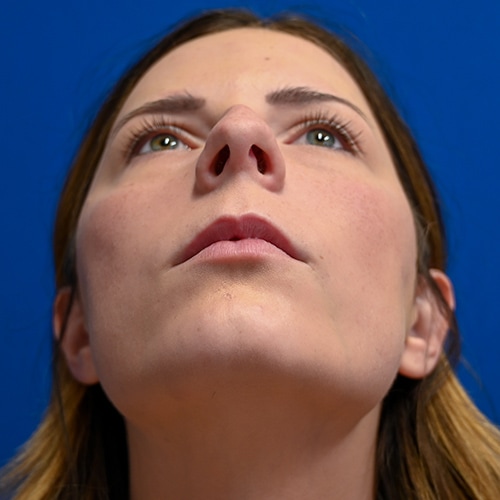 Rhinoplasty Before & After Image