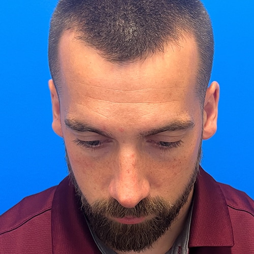 Rhinoplasty Before & After Image