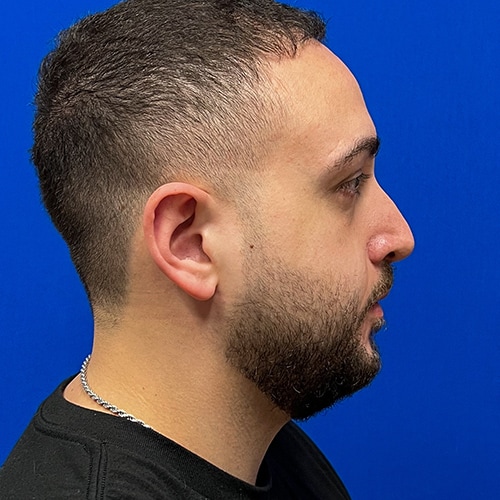 Rhinoplasty Before & After Image