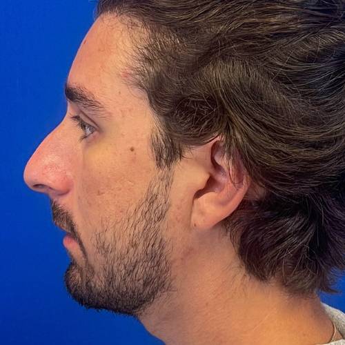 Rhinoplasty Before & After Image