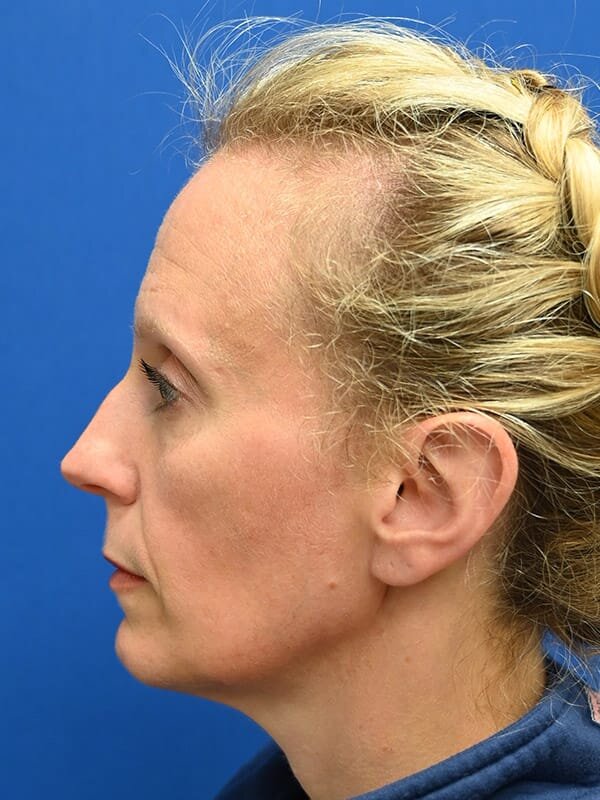 Rhinoplasty Before & After Image