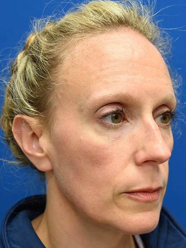 Rhinoplasty Before & After Image