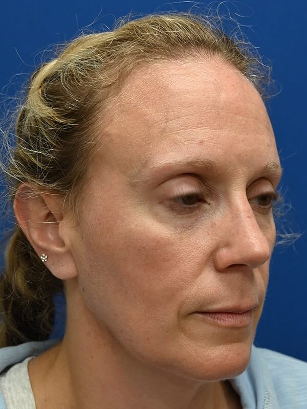 Rhinoplasty Before & After Image