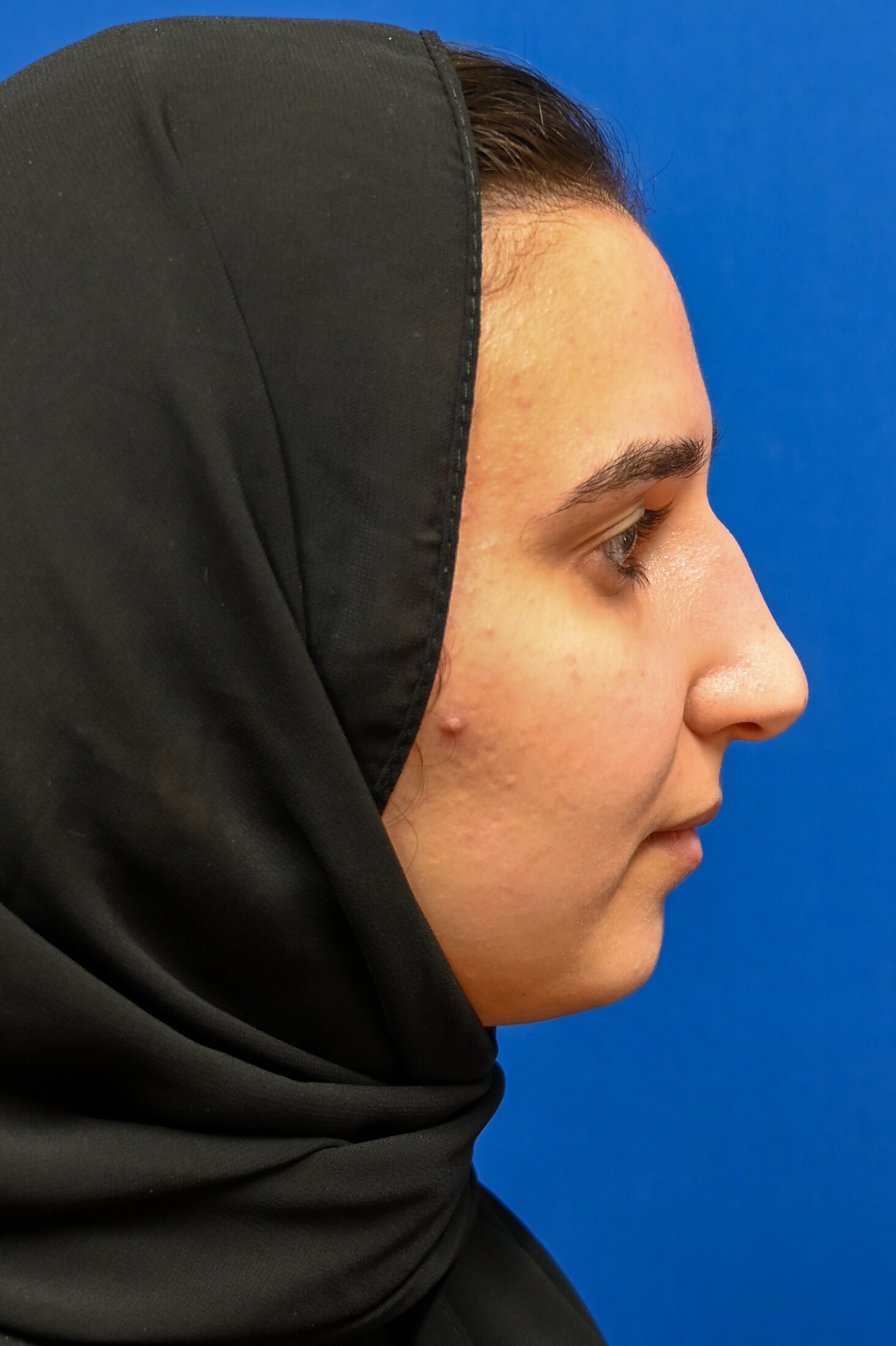 Rhinoplasty Before & After Image