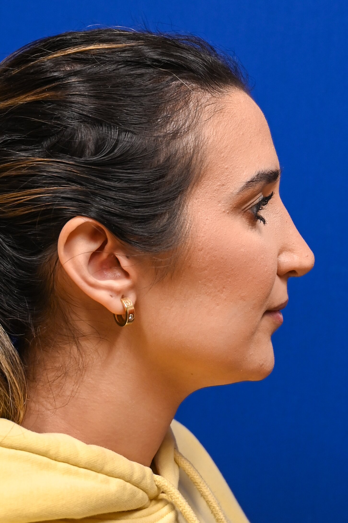 Rhinoplasty Before & After Image