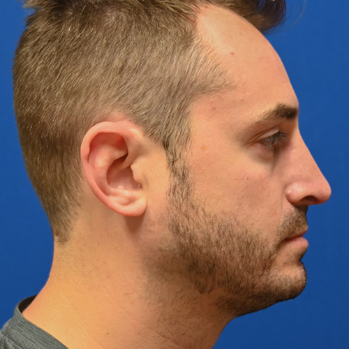 Rhinoplasty Before & After Image