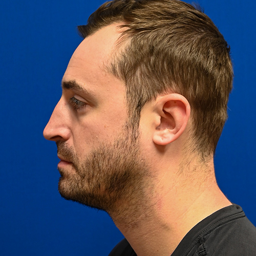 Rhinoplasty Before & After Image