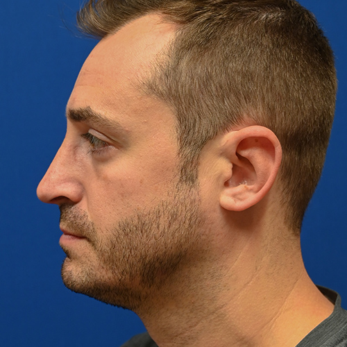 Rhinoplasty Before & After Image