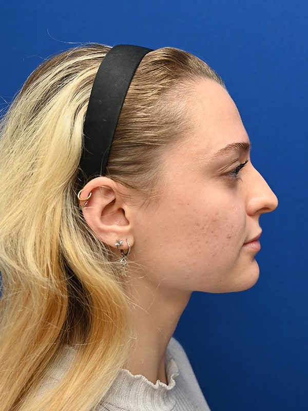 Rhinoplasty Before & After Image